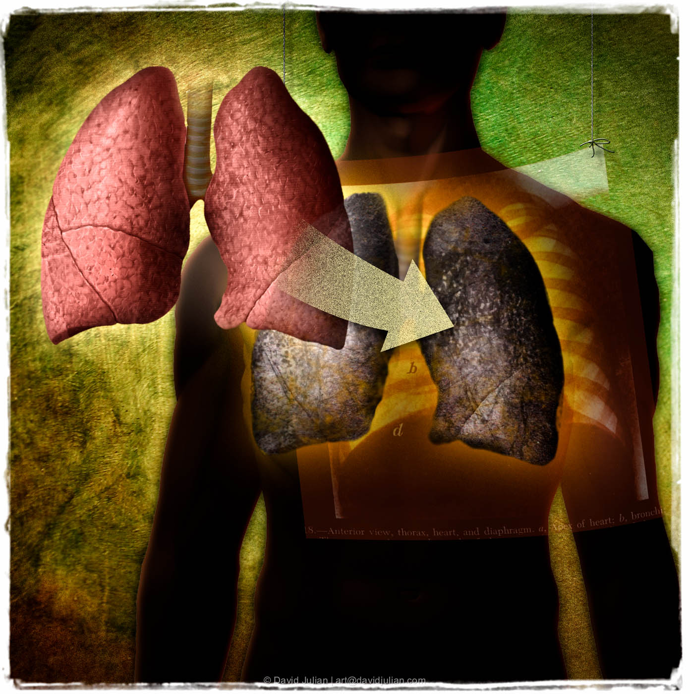 lungs_transplant_spot.jpg
